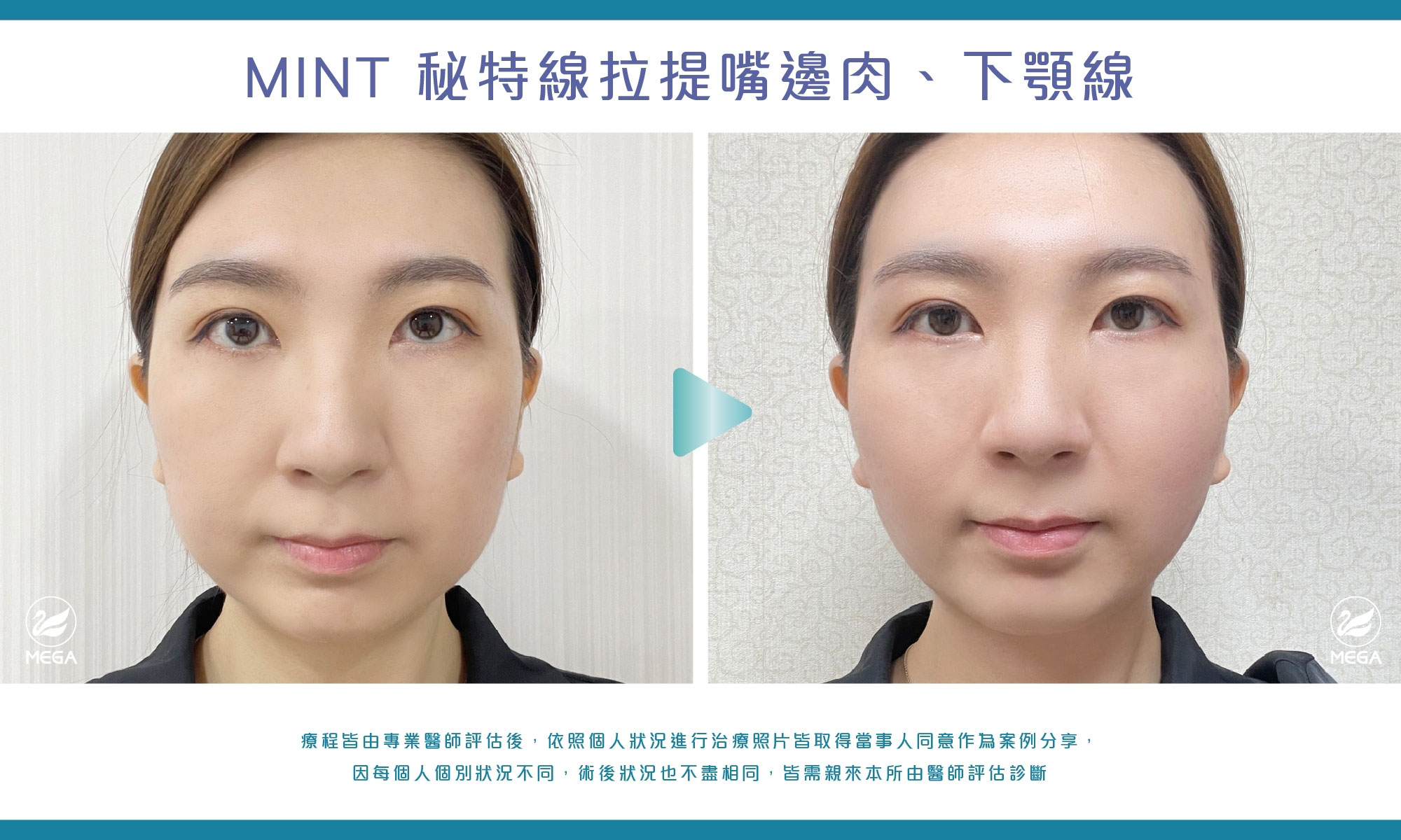 MINT 秘特線拉提嘴邊肉、下顎線案例