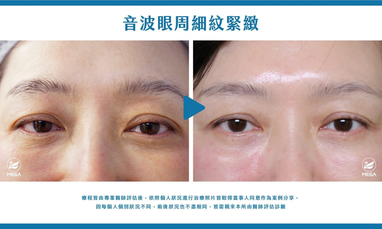 美加醫美音波眼周細紋緊緻案例