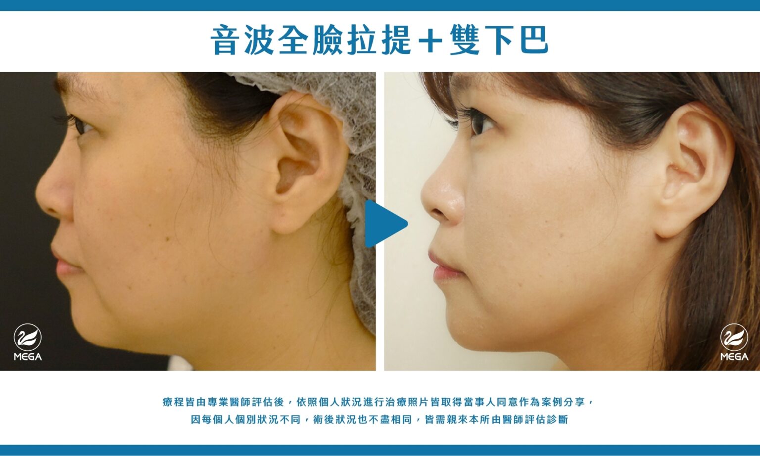 美加醫美音波全臉拉提＋雙下巴緊實案例