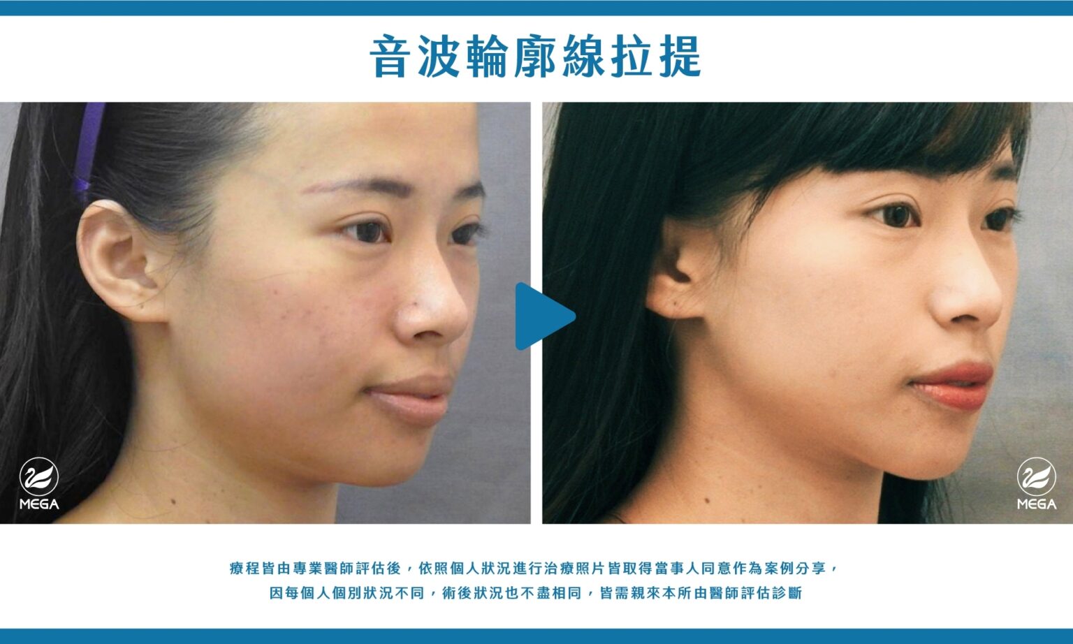美加醫美音波輪廓線拉提案例