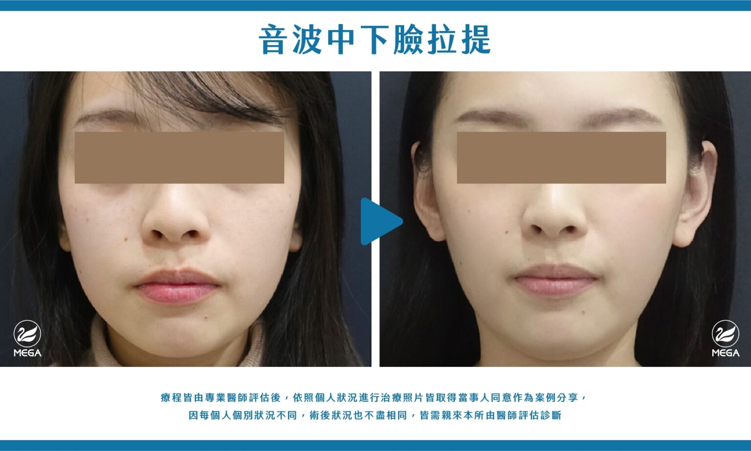 美加醫美音波中下臉拉提案例