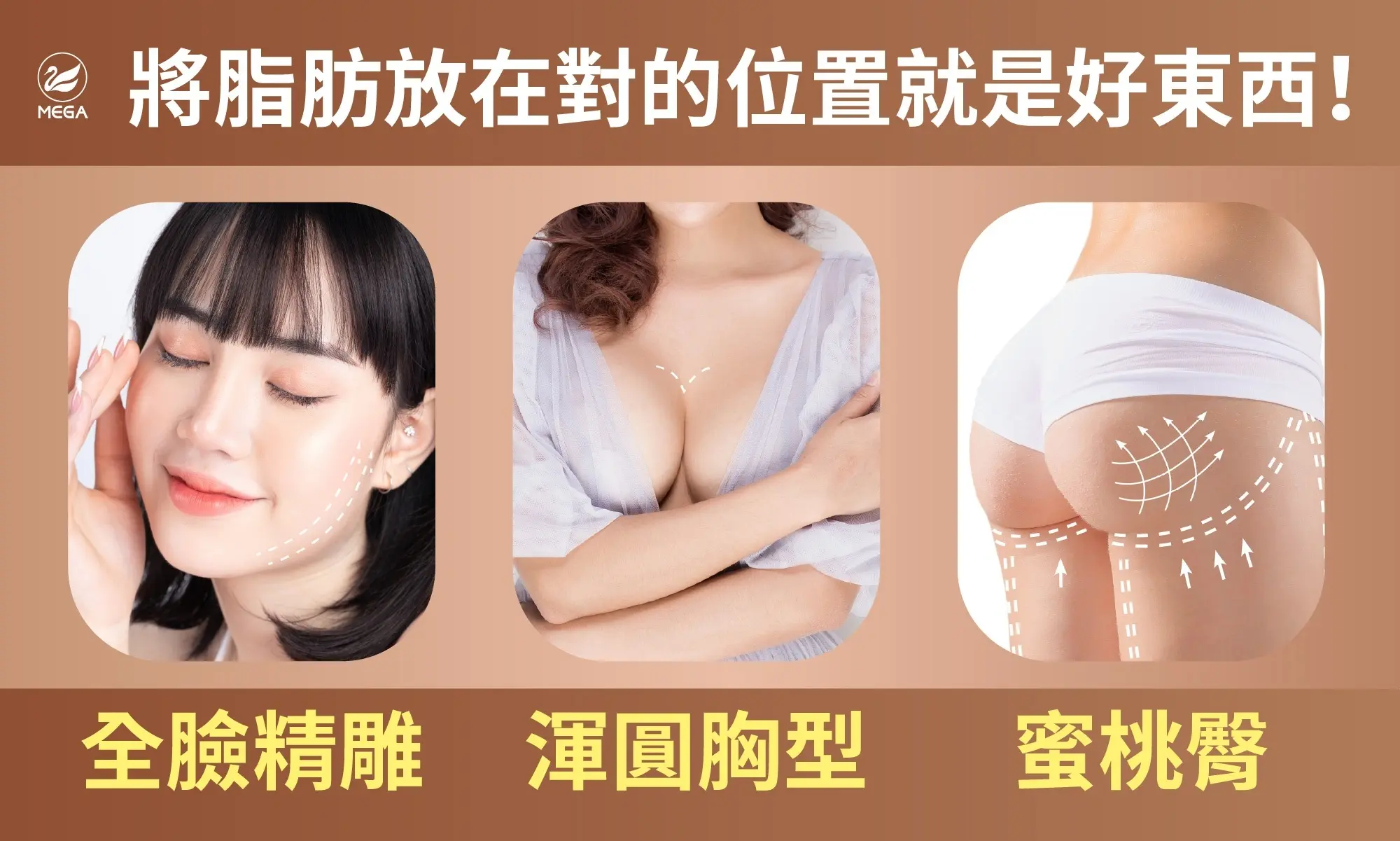 脂肪轉移術把脂肪放在對的位置就是好東西：全臉精雕、渾圓胸型、蜜桃臀