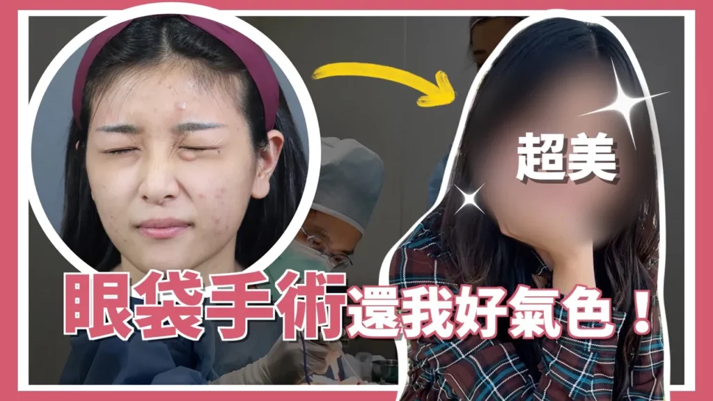 【玩美影音】眼袋手術還我好氣色！擺脫化妝遮也遮不了的淚溝＆眼袋