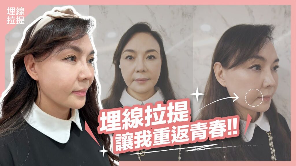 【玩美影音】密特線緊緻臉部肌膚，埋線拉提帶我重返18歲！