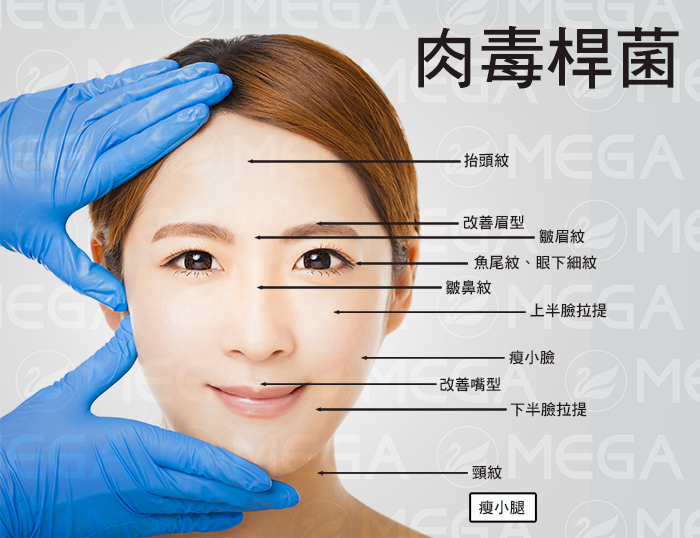 肉毒桿菌適用部位