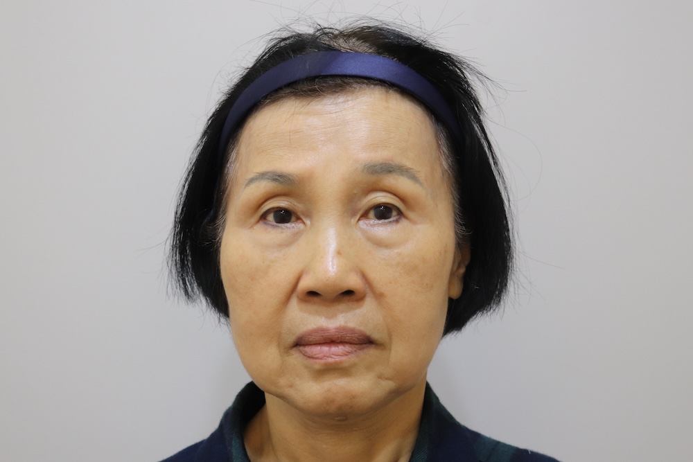 眼袋手術案例
