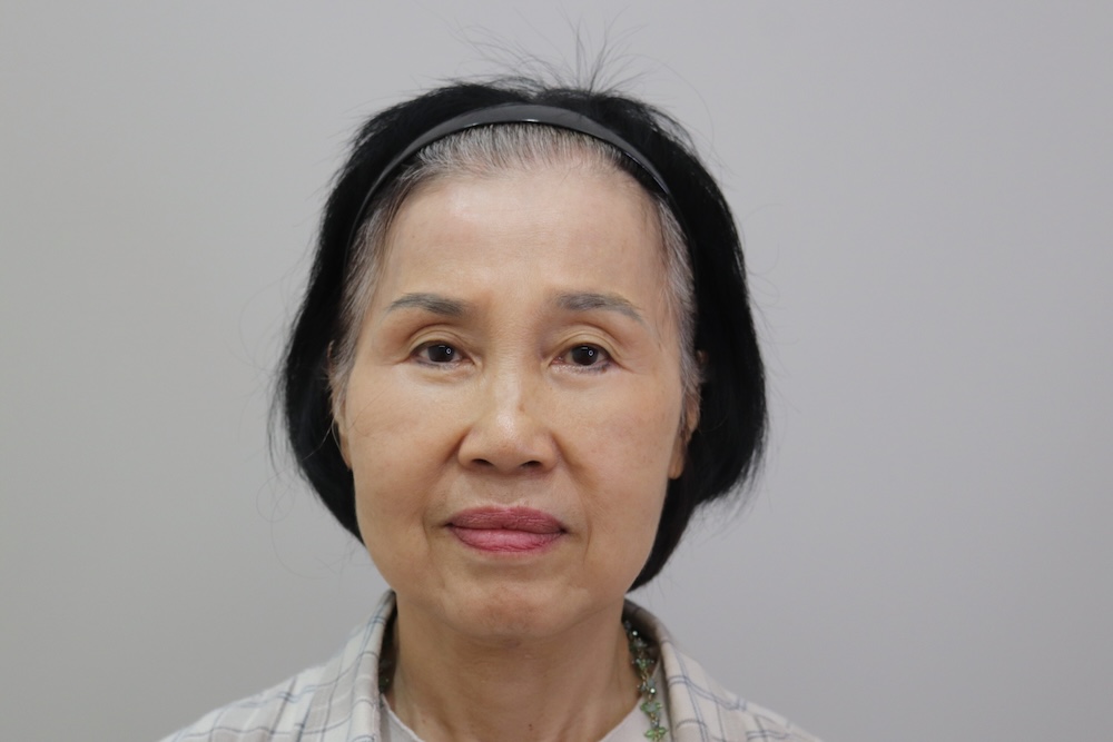 眼袋手術案例