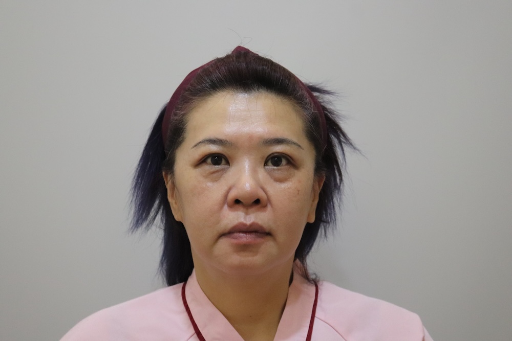 眼袋手術案例