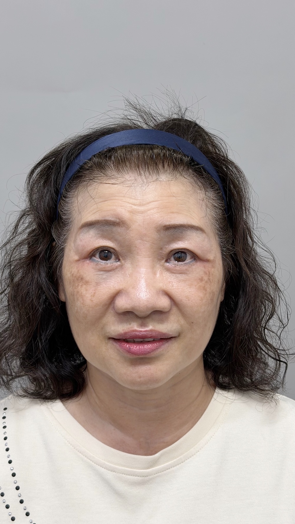 眼袋手術案例