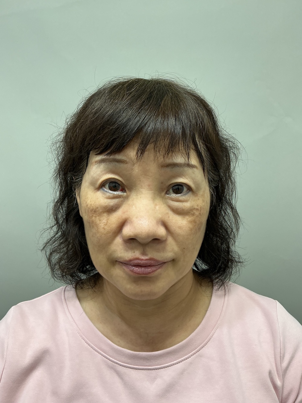 眼袋手術案例