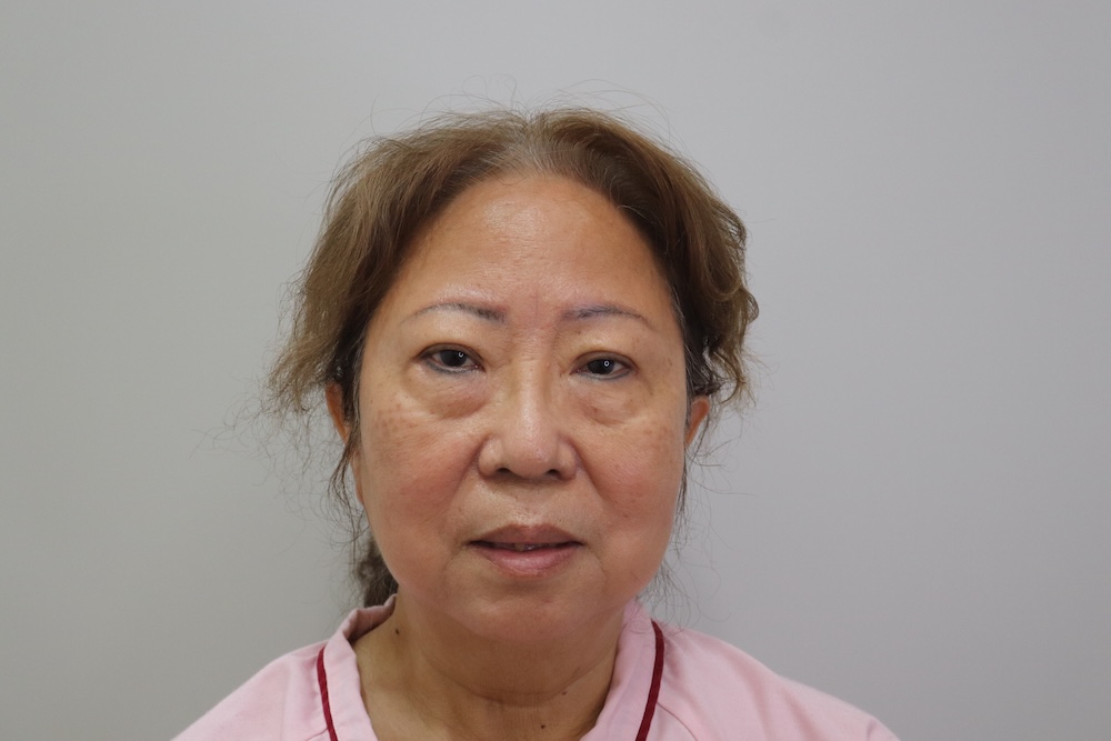 眼袋手術案例