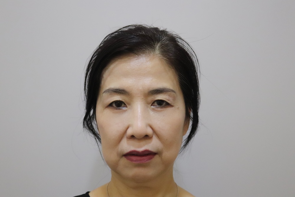 眼袋手術案例