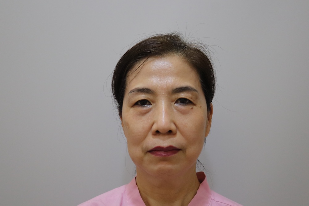眼袋手術案例