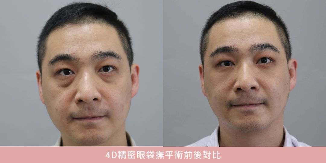 眼袋手術前後對比圖