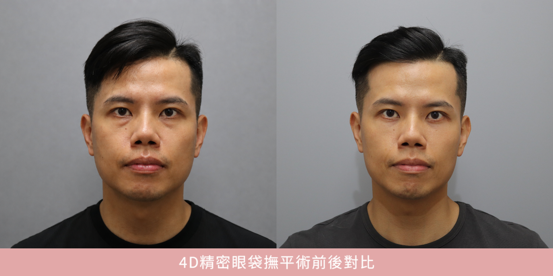 39歲眼袋手術案例｜不想再看起來像沒睡飽