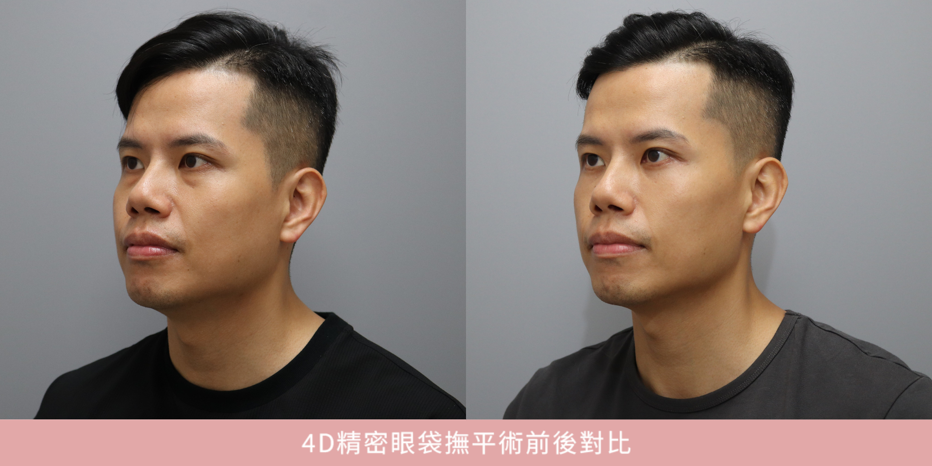 39歲眼袋案例|明明睡飽了,為什麼還是看起來很累?