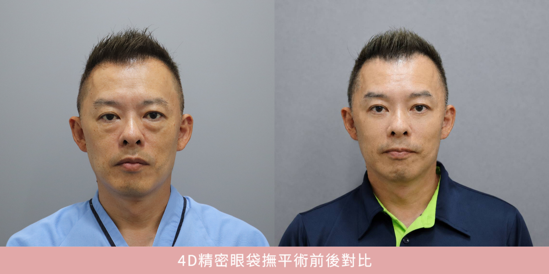 Andy老爹_4D精密眼袋撫平術