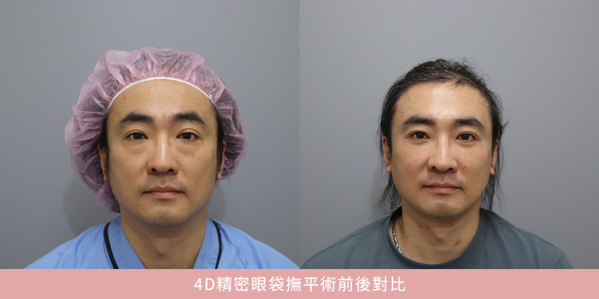 44歲工程主管鄭先生眼袋手術前後對比，改善眼袋與眼下疲憊感