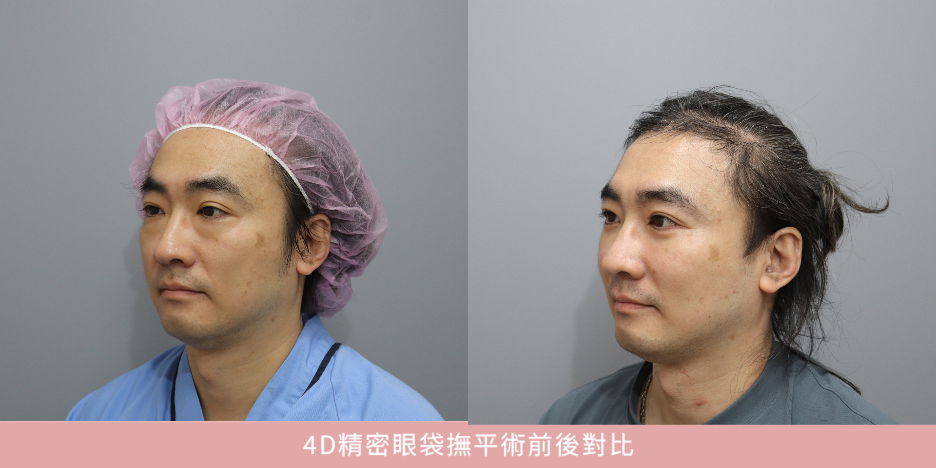 工程主管眼袋手術案例|「能說服我,我就做」